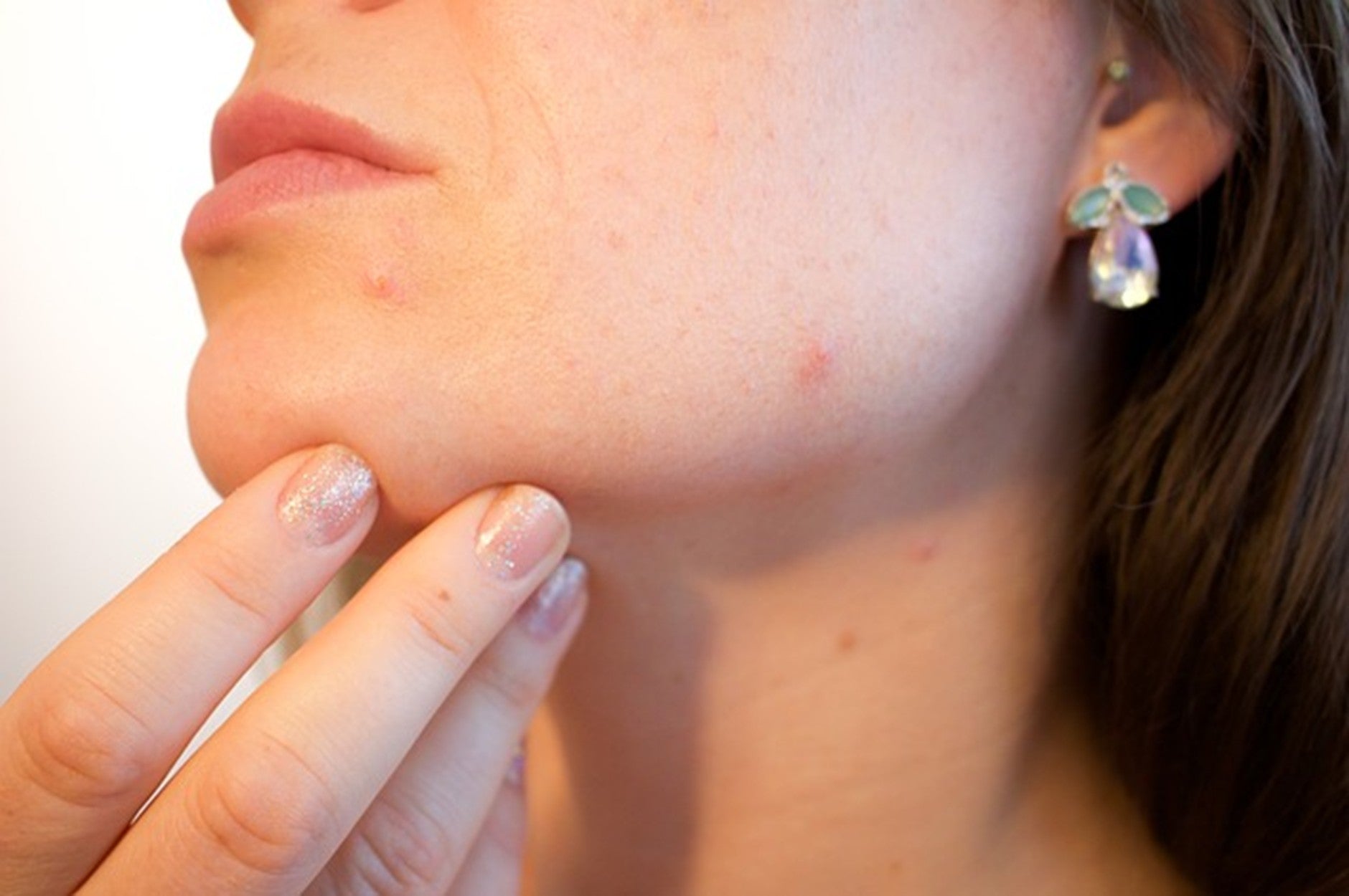 What Causes Acne? Common Triggers & How to Reduce Breakouts