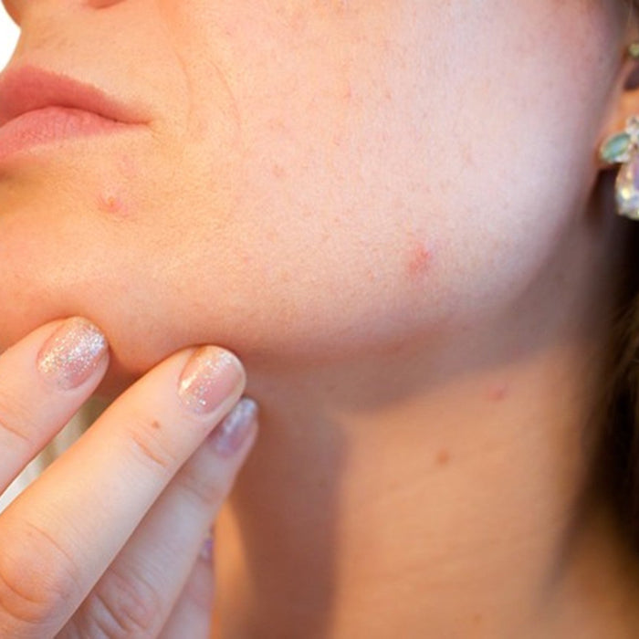 What Causes Acne? Common Triggers & How to Reduce Breakouts