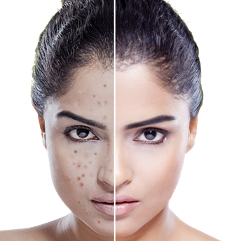 Acne: Causes, Symptoms & Natural Treatment