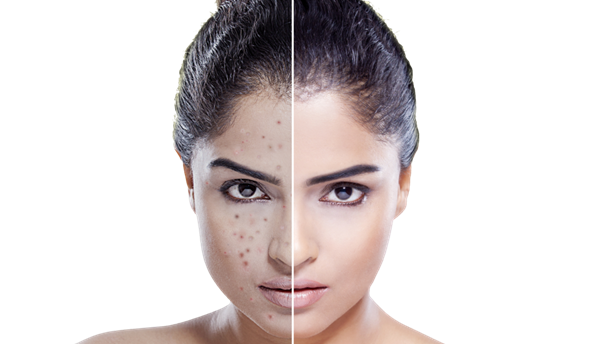 Acne: Causes, Symptoms & Natural Treatment