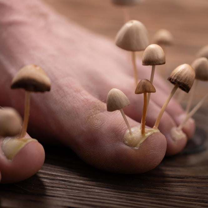 Fungal Skin Infections: Causes, Symptoms & Natural Treatment