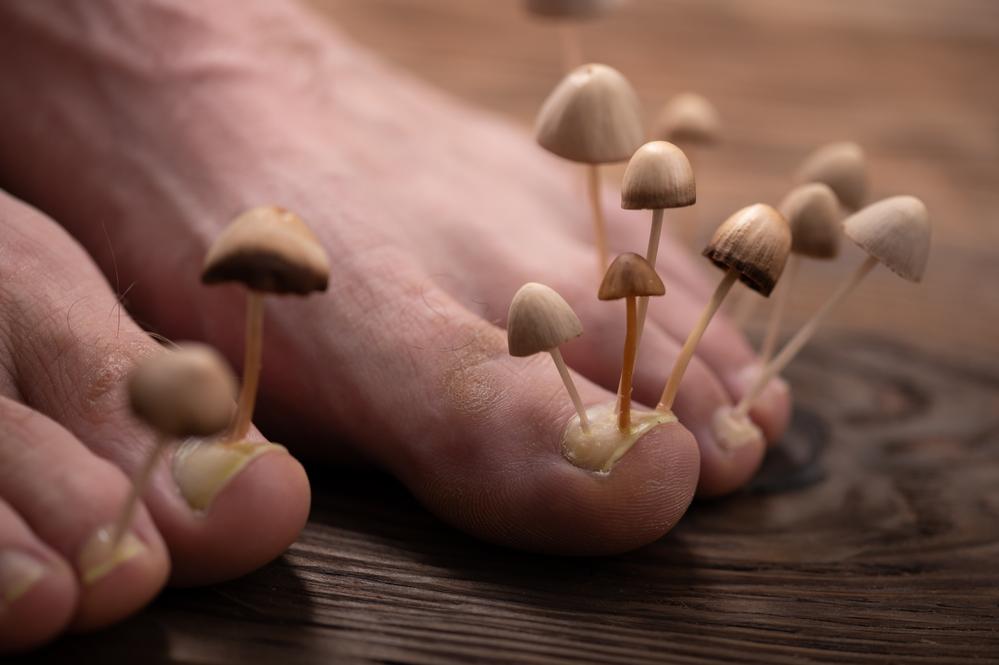 Fungal Skin Infections: Causes, Symptoms & Natural Treatment