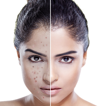 Manuka oil for girls, how to save your beautiful complexion