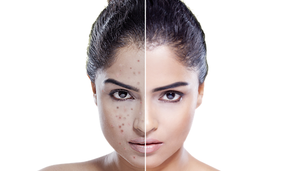 Manuka oil for girls, how to save your beautiful complexion