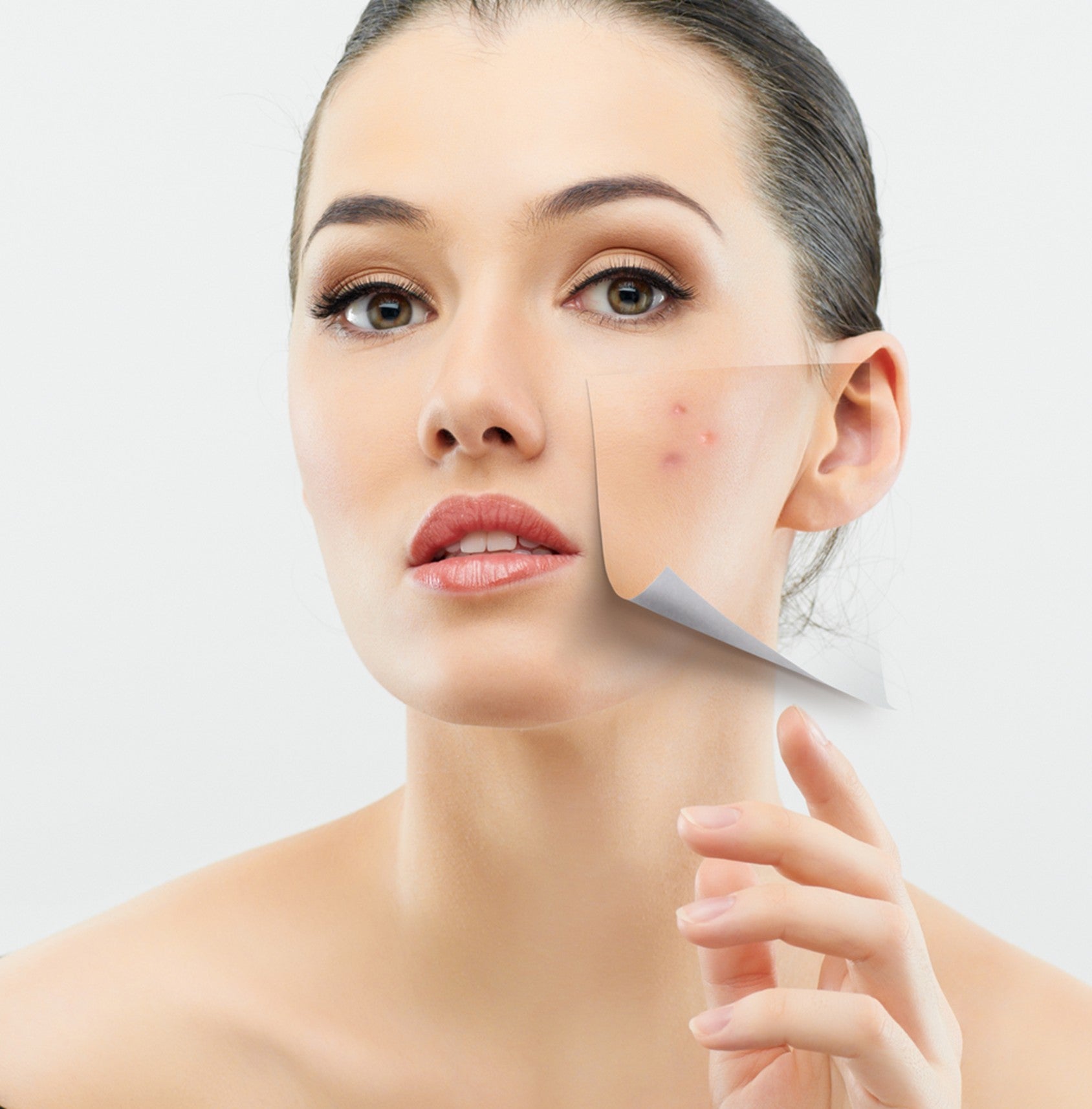 How to Treat Acne Naturally (Step-by-Step Guide)