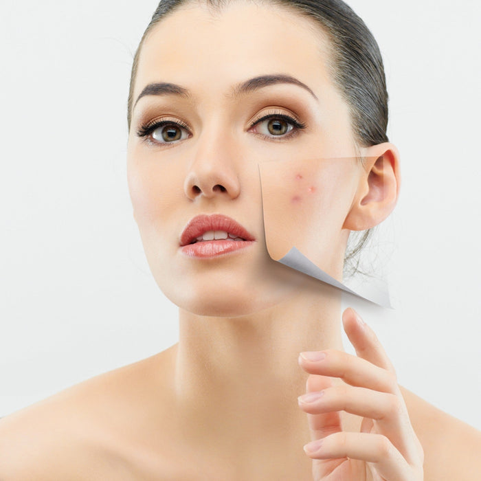 How to Treat Acne Naturally (Step-by-Step Guide)